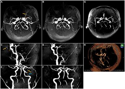 Case report: Sphenoid wing dural arteriovenous fistula draining into ophthalmic veins inducing pulsatile tinnitus as the sole symptom and its spontaneous closure